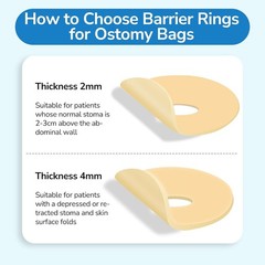 Protective Ostomy Bag Seal Rings 2–4mm Moldable Hydrocolloid Barrier 10 or 30PCS