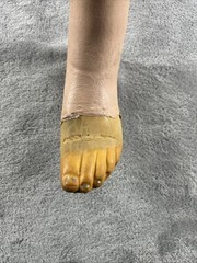 Vintage Left Above Knee Prosthetic Leg Please Read