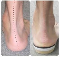 3 Pair Custom Orthotics Custom Arch Supports for Feet Ankles Knees Back and Neck