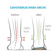 Footscientific Arches Insoles Type 3 – Supination/High Arch Mens Size 8-8.5 /