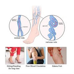 Gradient Compression with Silicone Band Unisex 20-30mmHg Best for Varicose Vein