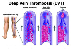 30-40mmHg Compression Stockings Thigh High Medical Support Prevent Varicose Vein