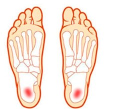 Pedag Ultra Heel 174 heel cup pads, reduce heel spurs pain and plantar fasciitis
