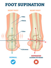Pedag Correct Plus 129347 orthotic insole, helps with over supination alignment