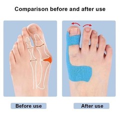 10PCS Bunion Corrector Kinesiology Tape Pain Relief Big Toe Spacer Support