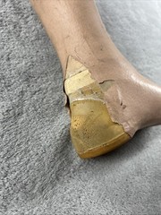 Vintage Left Above Knee Prosthetic Leg Please Read