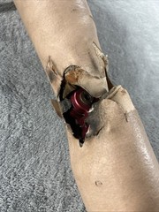Vintage Left Above Knee Prosthetic Leg Please Read