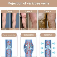 Pantyhose Compression Stockings 30-40 mmHg Relief Medical Supports Therapy Vein