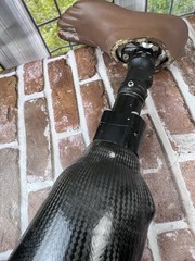 Complete Prosthetic Right Leg Knee WillowWood Limblogic Trulife