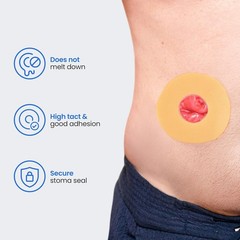 High-Tact & Stretchable 2″ Adhesive Stoma Seals – 10 Count for Comfort & Fit