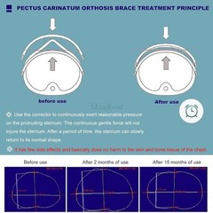 Upgraded Kids Pectus Carinatum Chest Brace Adjustable Support with Extra Straps