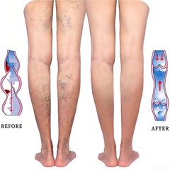Thigh High Compression Stockings – Leg Support & Pain Relief for Men & Women USA