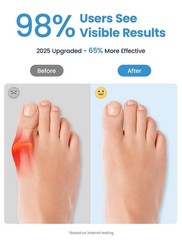 Habioer Bunion Corrector Toe Separators for Big Toe Pain Relief