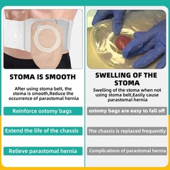 Ostomy Belt, Adjustable Stoma Support Belt, Universal Ileostomy Colostomy Bel…