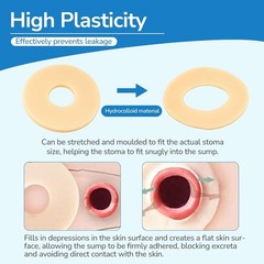 Protective Ostomy Bag Seal Rings 2–4mm Moldable Hydrocolloid Barrier 10 or 30PCS