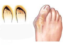 2X Silicone Gel Bunion Toe Protector Straightener Corrector Spreader Splint Pads
