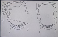 Breast Compression Device Prevent Eliminate Capsular Contracture