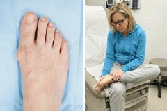 Treatment Bunion Fix ,Toe Valgus Corrector Adjustable Orthosis Women Men Splints