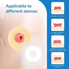 Protective Ostomy Bag Seal Rings 2–4mm Moldable Hydrocolloid Barrier 10 or 30PCS