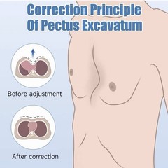 Pectus Excavatum Orthosis Sternum Chest Brace Vacuum Bell For All Ages Large