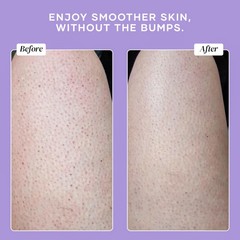 DERMAdoctor KP Bump Eraser Body Scrub 10% AHAs + PHAs Keratosis Pilaris Treatmen