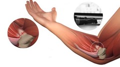 2X Tennis Elbow Brace Support Arthritis Tendonitis Joint Strap Band Wrap Sports