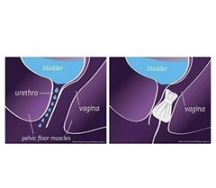 Poise Impressa Bladder Supports, 10 count, size 1, New, Sealed Box, Exp2019